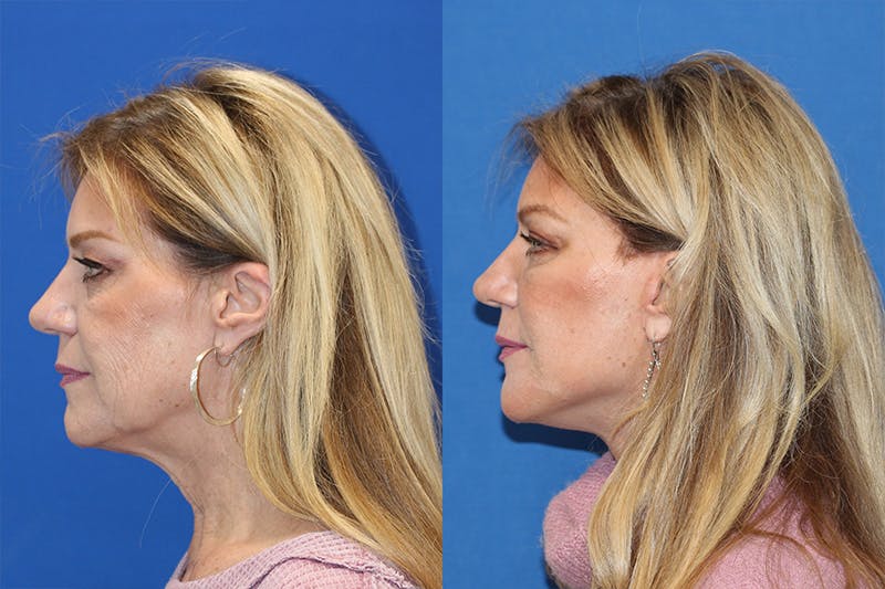 Vertical Restore® / Facial Rejuvenation Before & After Gallery - Patient 71701284 - Image 2
