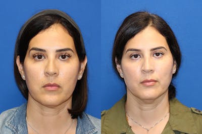 Vertical Restore® / Facial Rejuvenation Before & After Gallery - Patient 71701286 - Image 1