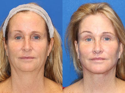 Fat Transfer Before & After Gallery - Patient 71701287 - Image 1