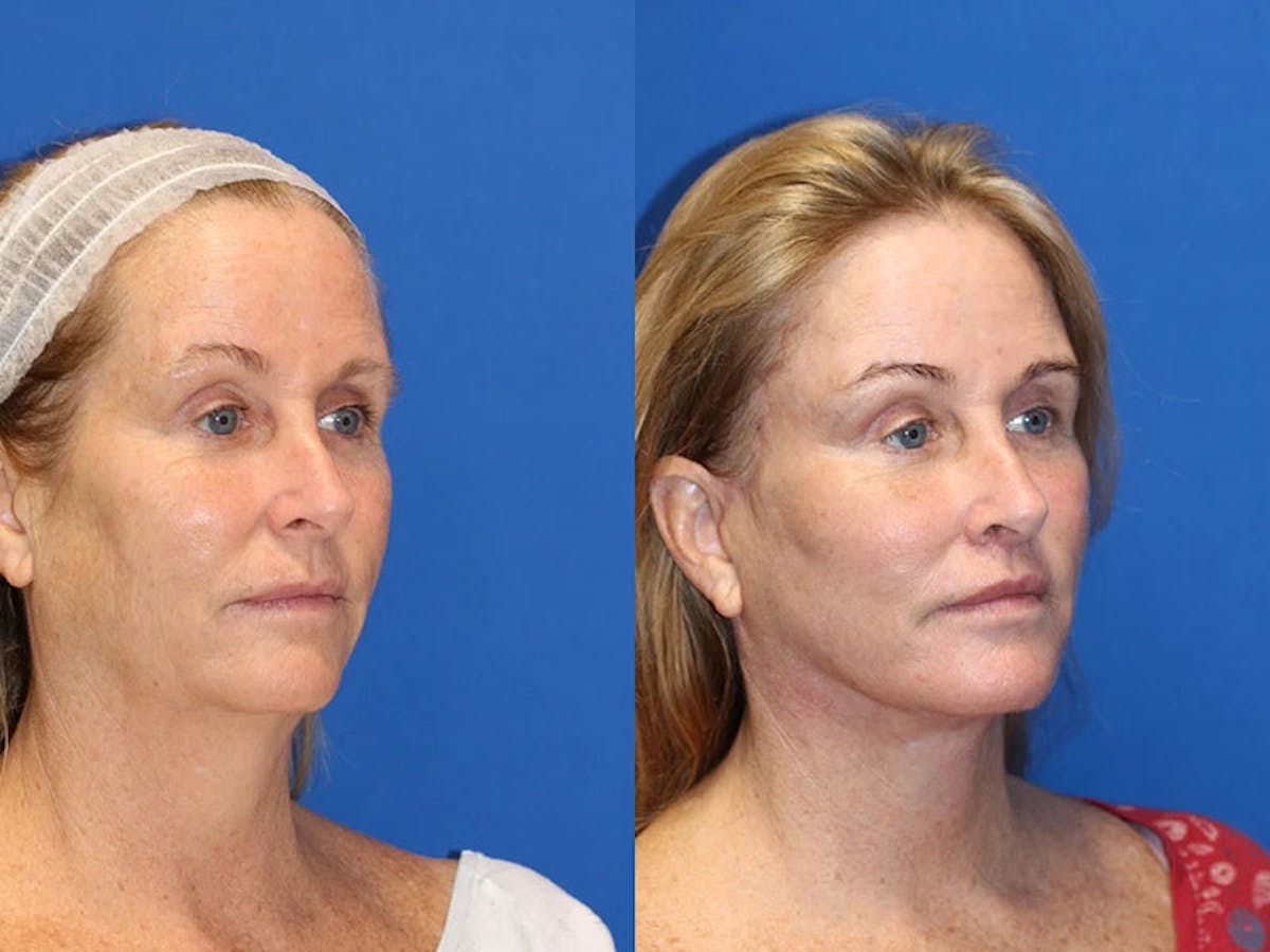 Fat Transfer Before & After Gallery - Patient 71701287 - Image 2