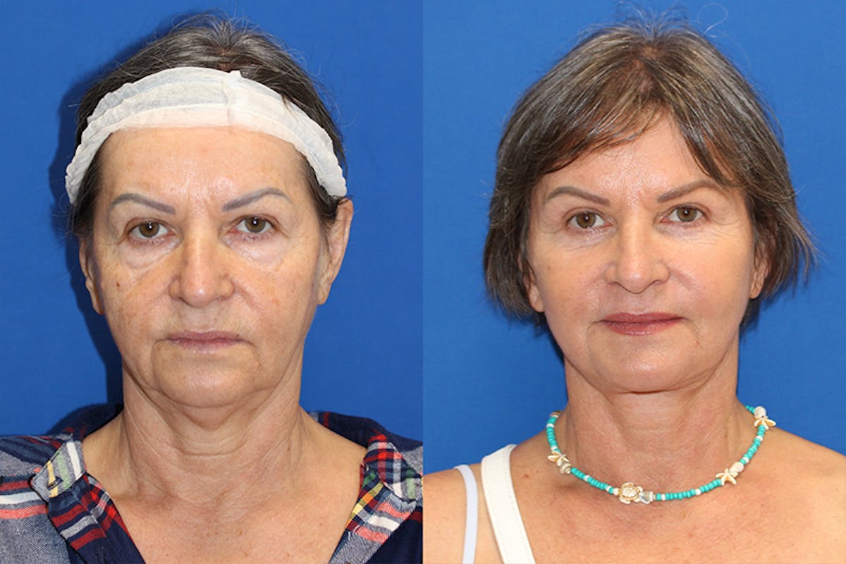 Vertical Restore® / Facial Rejuvenation Before & After Gallery - Patient 71701292 - Image 1