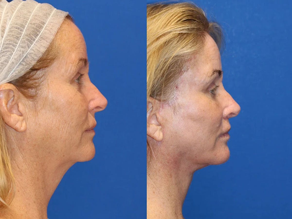 Fat Transfer Before & After Gallery - Patient 71701287 - Image 3