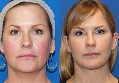 Fat Transfer Before & After Gallery - Patient 71701294 - Image 1