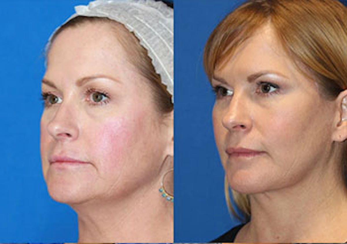 Fat Transfer Before & After Gallery - Patient 71701294 - Image 2