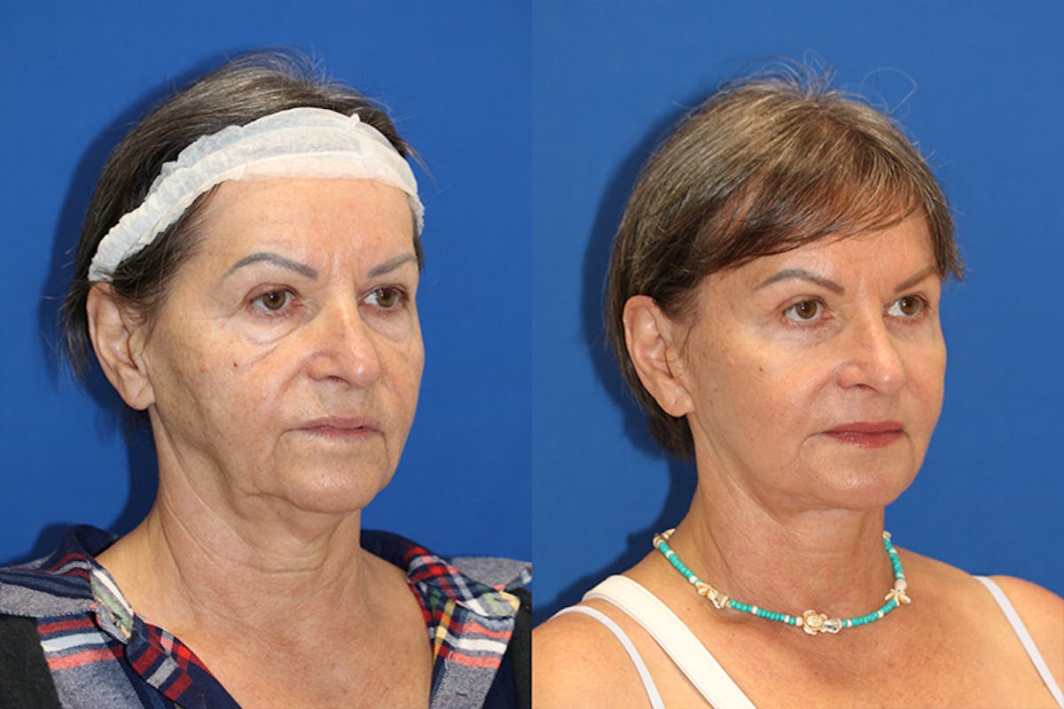 Vertical Restore® / Facial Rejuvenation Before & After Gallery - Patient 71701292 - Image 3