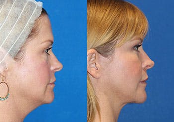 Fat Transfer Before & After Gallery - Patient 71701294 - Image 3