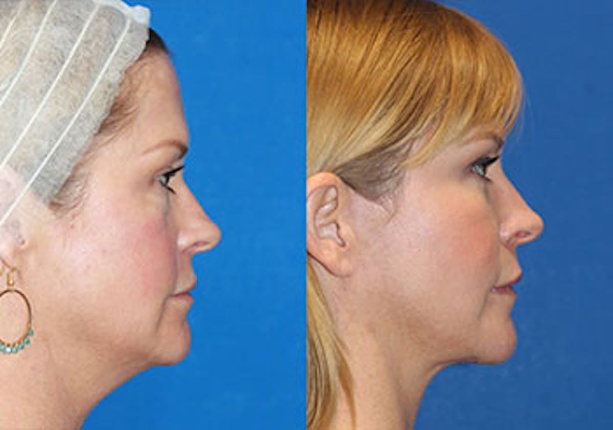Fat Transfer Before & After Gallery - Patient 71701294 - Image 3