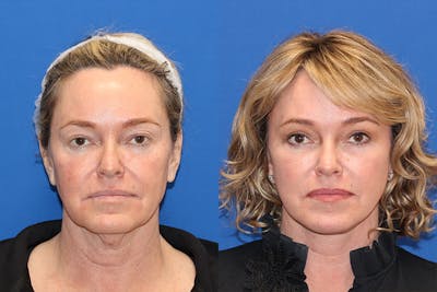Vertical Restore® / Facial Rejuvenation Before & After Gallery - Patient 71701301 - Image 1