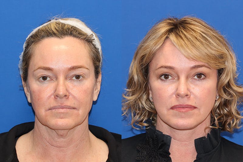 Vertical Restore® / Facial Rejuvenation Before & After Gallery - Patient 71701301 - Image 1