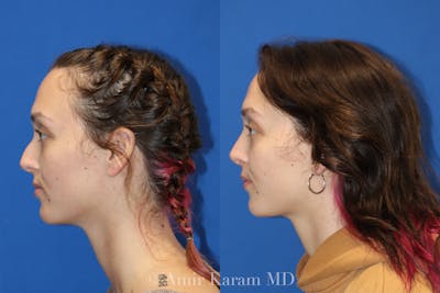 Rhinoplasty Before & After Gallery - Patient 71701300 - Image 1