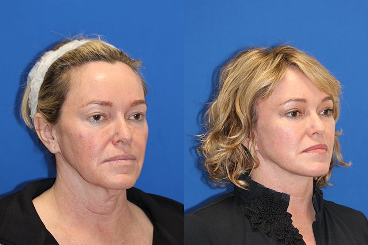 Vertical Restore® / Facial Rejuvenation Before & After Gallery - Patient 71701301 - Image 2