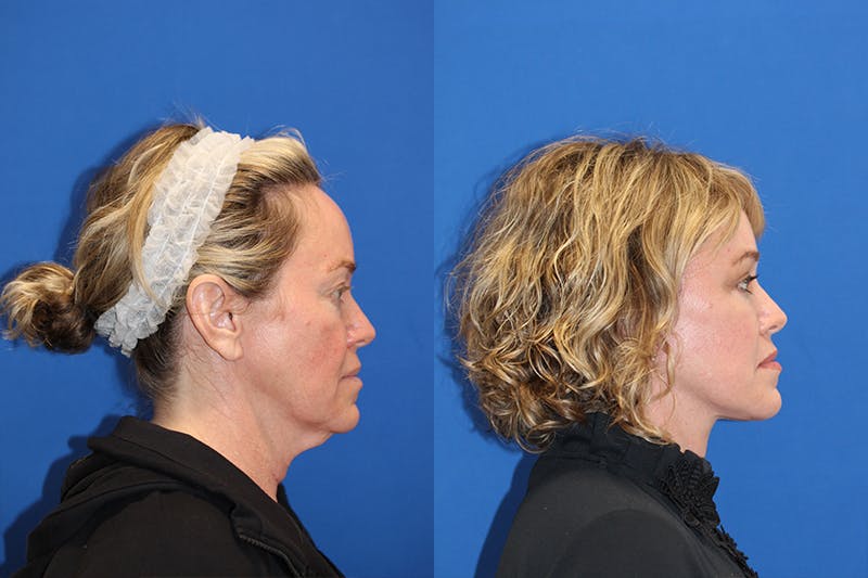 Vertical Restore® / Facial Rejuvenation Before & After Gallery - Patient 71701301 - Image 3