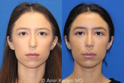 Rhinoplasty Before & After Gallery - Patient 71701303 - Image 1