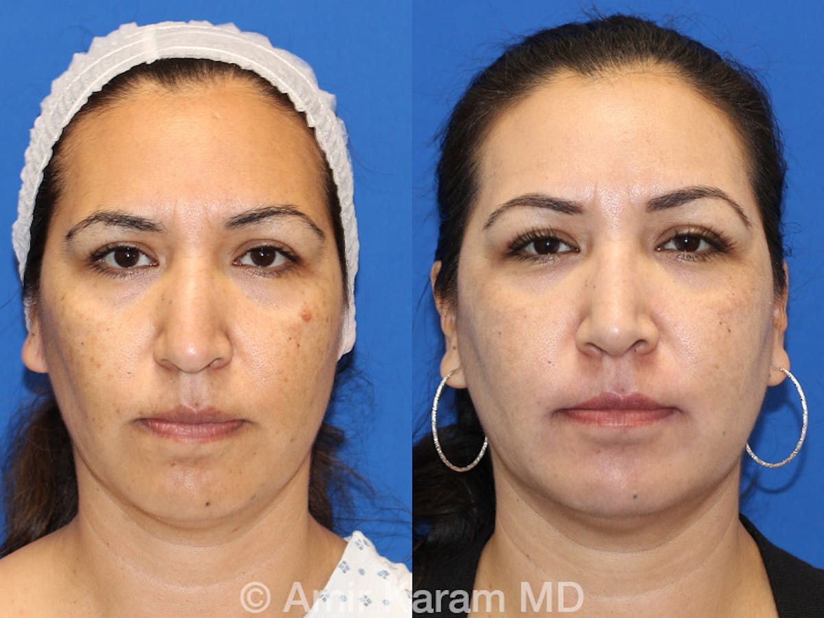 Rhinoplasty Before & After Gallery - Patient 71701306 - Image 1