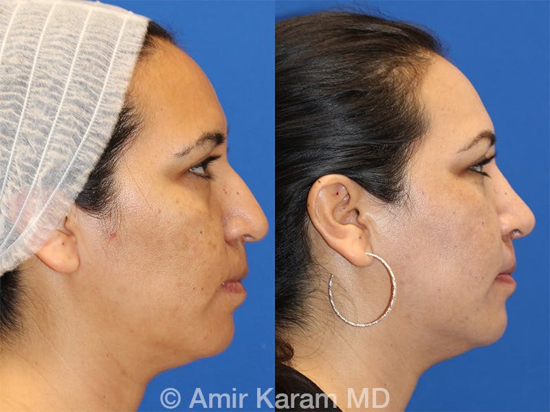 Rhinoplasty Before & After Gallery - Patient 71701306 - Image 2