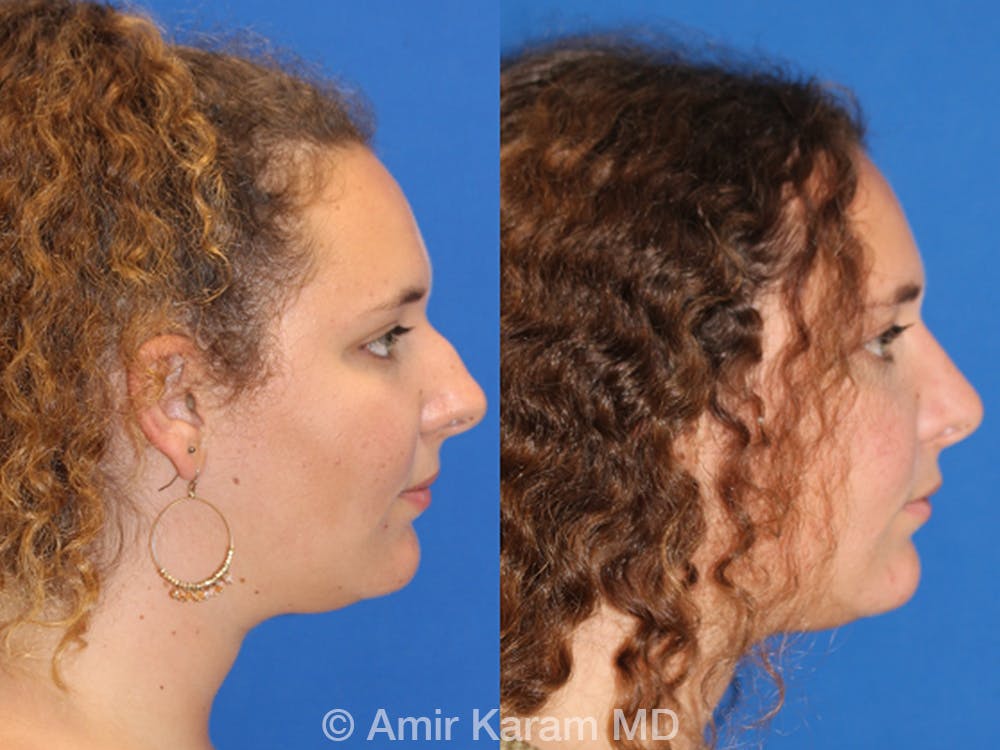 Rhinoplasty Before & After Gallery - Patient 71701311 - Image 1