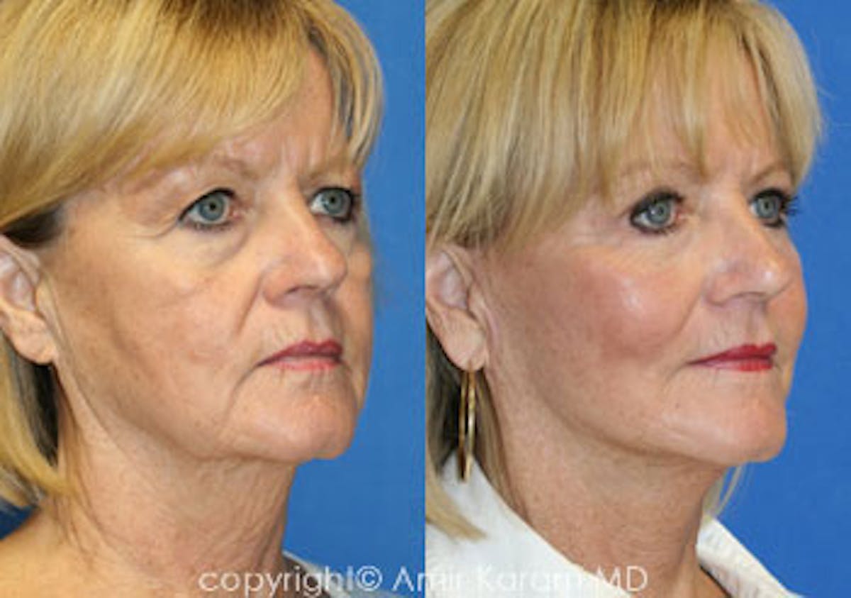 Fat Transfer Before & After Gallery - Patient 71701320 - Image 1