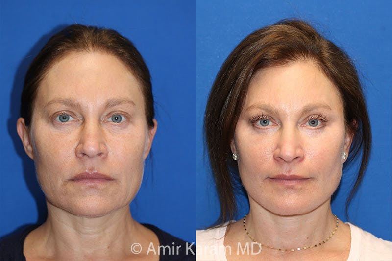 Vertical Restore® / Facial Rejuvenation Before & After Gallery - Patient 71701323 - Image 1