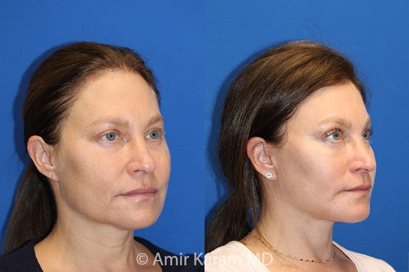 Vertical Restore® / Facial Rejuvenation Before & After Gallery - Patient 71701323 - Image 2