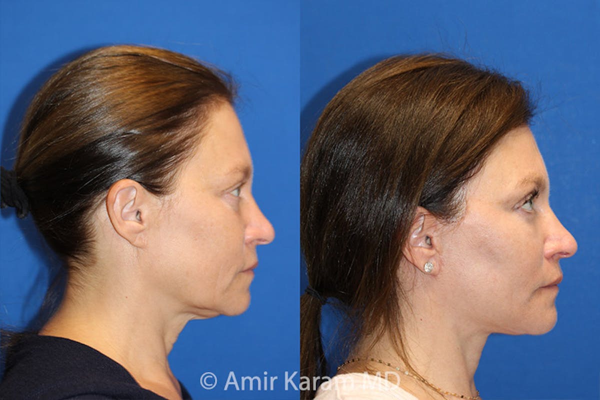 Vertical Restore® / Facial Rejuvenation Before & After Gallery - Patient 71701323 - Image 3