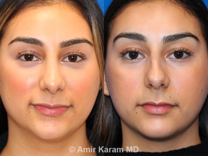 Rhinoplasty Before & After Gallery - Patient 71701336 - Image 1