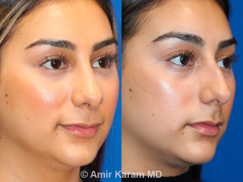 Rhinoplasty Before & After Gallery - Patient 71701336 - Image 2