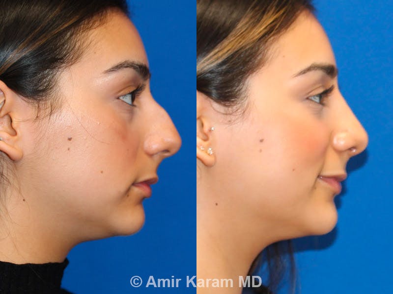 Rhinoplasty Before & After Gallery - Patient 71701336 - Image 3