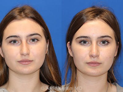 Rhinoplasty Before & After Gallery - Patient 71701339 - Image 1