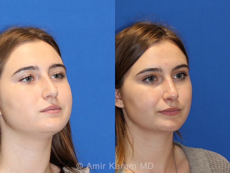 Rhinoplasty Before & After Gallery - Patient 71701339 - Image 2