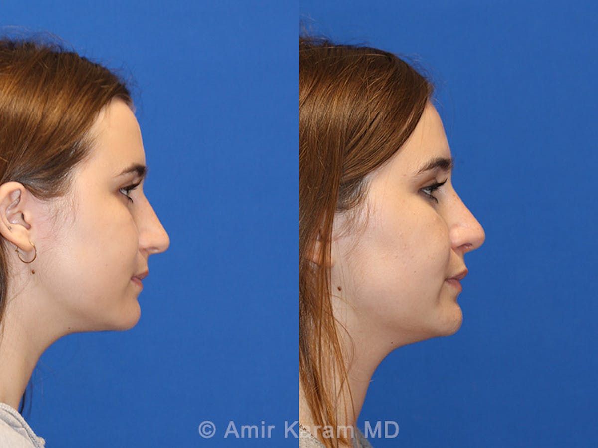 Rhinoplasty Before & After Gallery - Patient 71701339 - Image 3