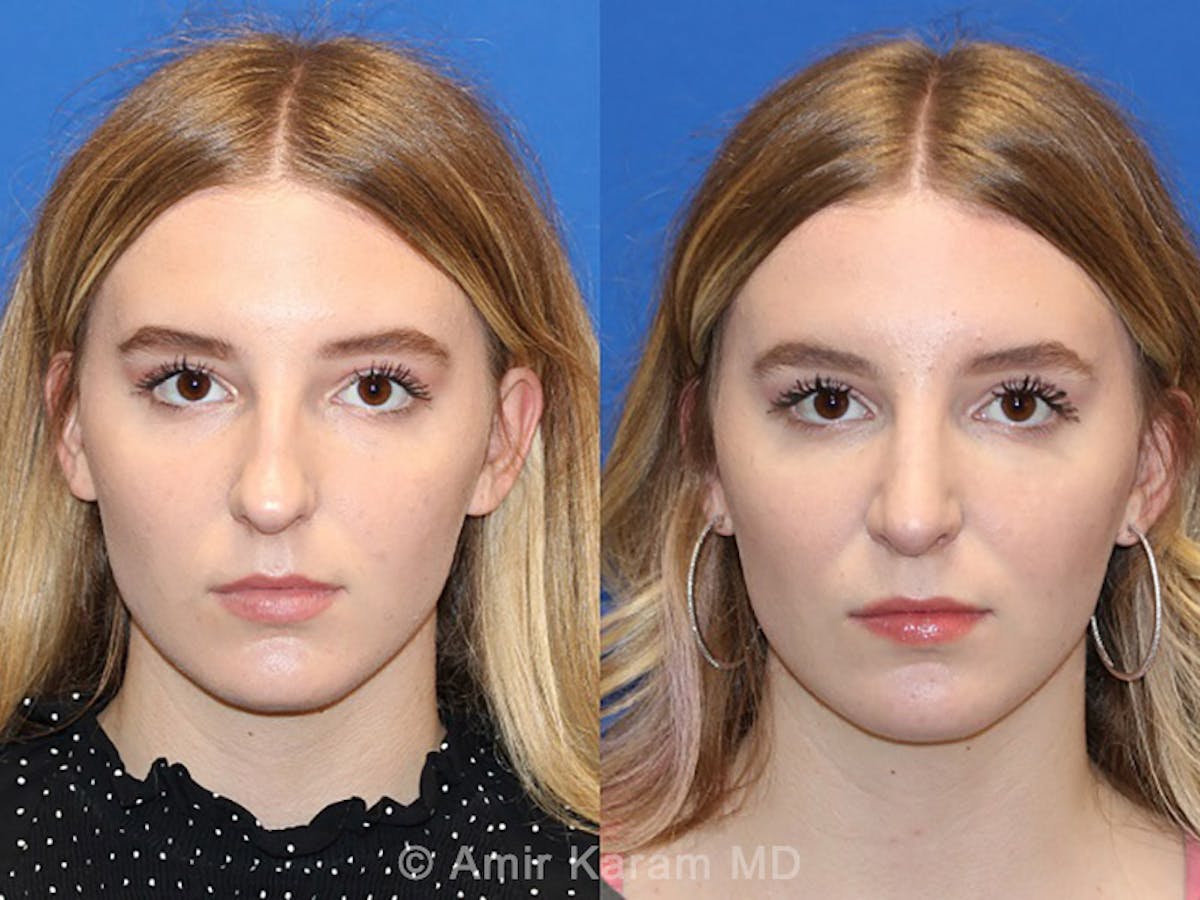 Rhinoplasty Before & After Gallery - Patient 71701346 - Image 1