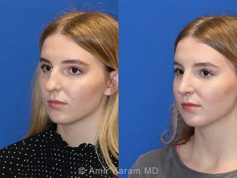 Rhinoplasty Before & After Gallery - Patient 71701346 - Image 2