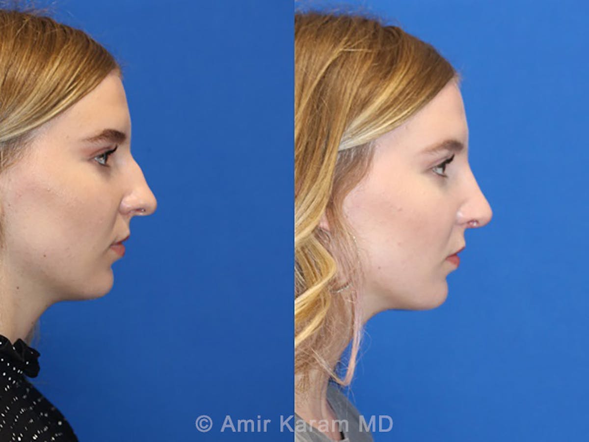 Rhinoplasty Before & After Gallery - Patient 71701346 - Image 3