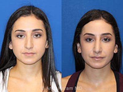 Rhinoplasty Before & After Gallery - Patient 71701357 - Image 1