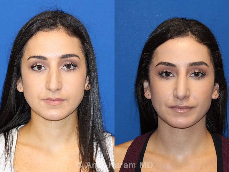 Rhinoplasty Before & After Gallery - Patient 71701357 - Image 1