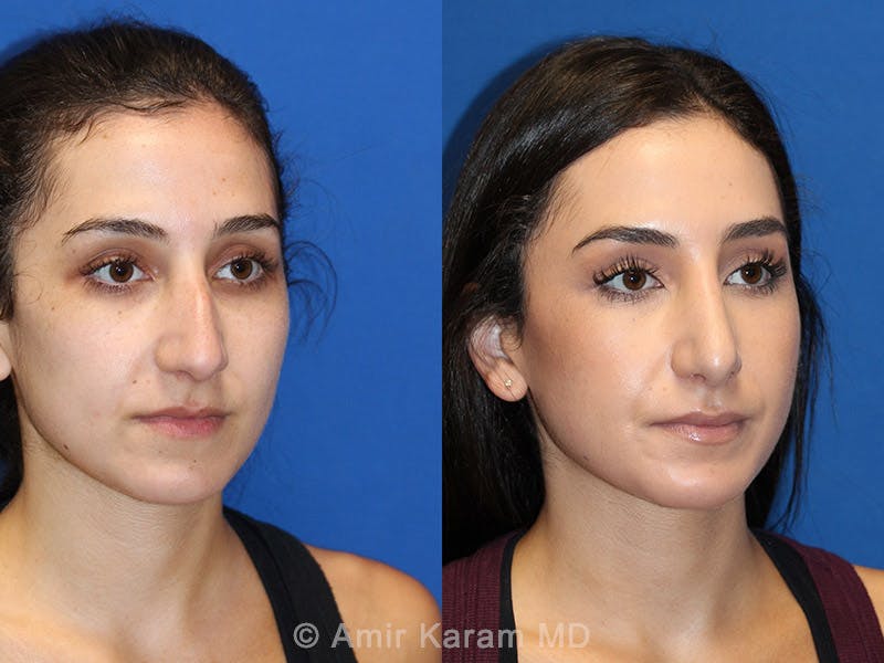 Rhinoplasty Before & After Gallery - Patient 71701357 - Image 2