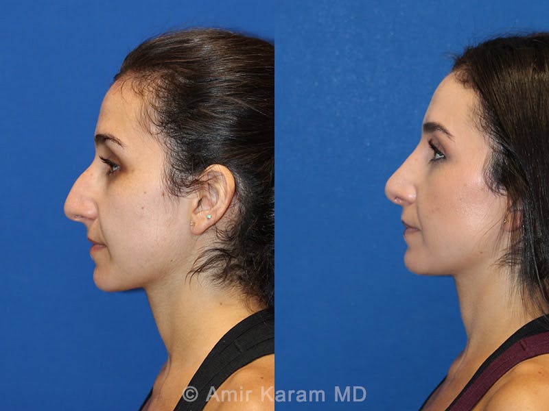 Rhinoplasty Before & After Gallery - Patient 71701357 - Image 3