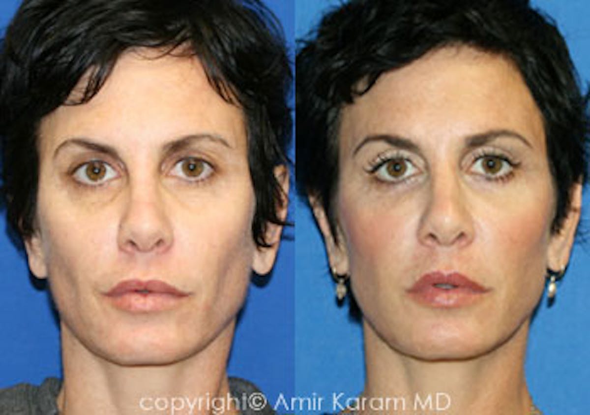 Fat Transfer Before & After Gallery - Patient 71701361 - Image 1
