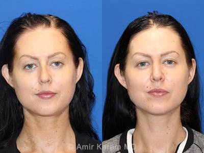 Rhinoplasty Before & After Gallery - Patient 71701360 - Image 1