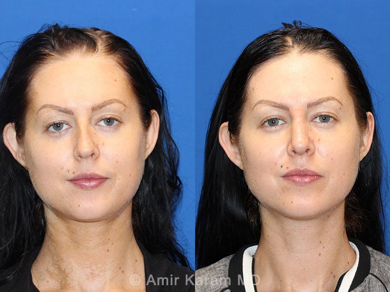 Rhinoplasty Before & After Gallery - Patient 71701360 - Image 1