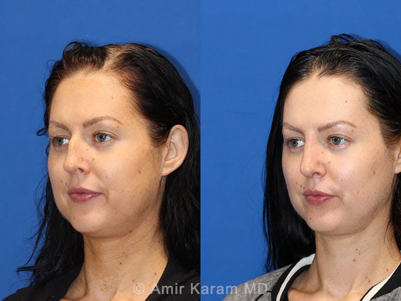 Rhinoplasty Before & After Gallery - Patient 71701360 - Image 2