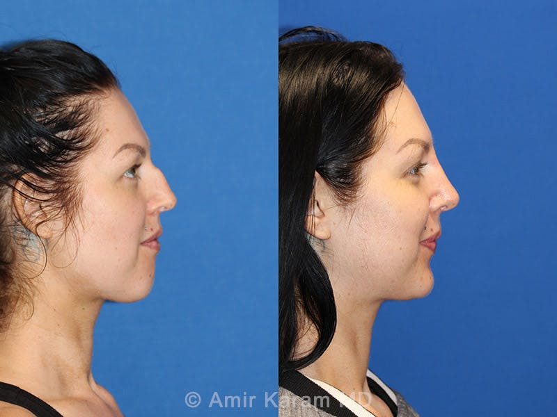 Rhinoplasty Before & After Gallery - Patient 71701360 - Image 3