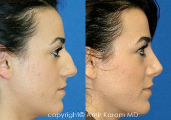 Rhinoplasty Before & After Gallery - Patient 71701368 - Image 1