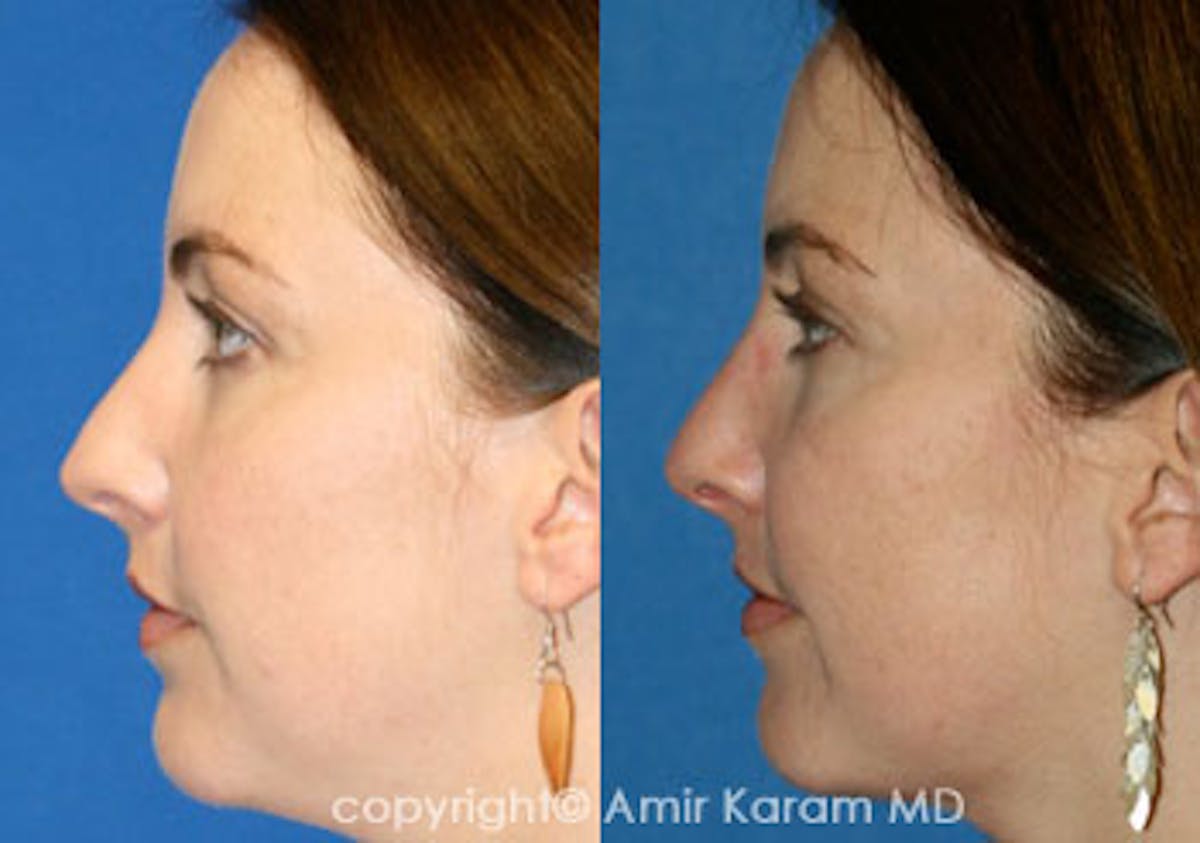 Rhinoplasty Before & After Gallery - Patient 71701370 - Image 1