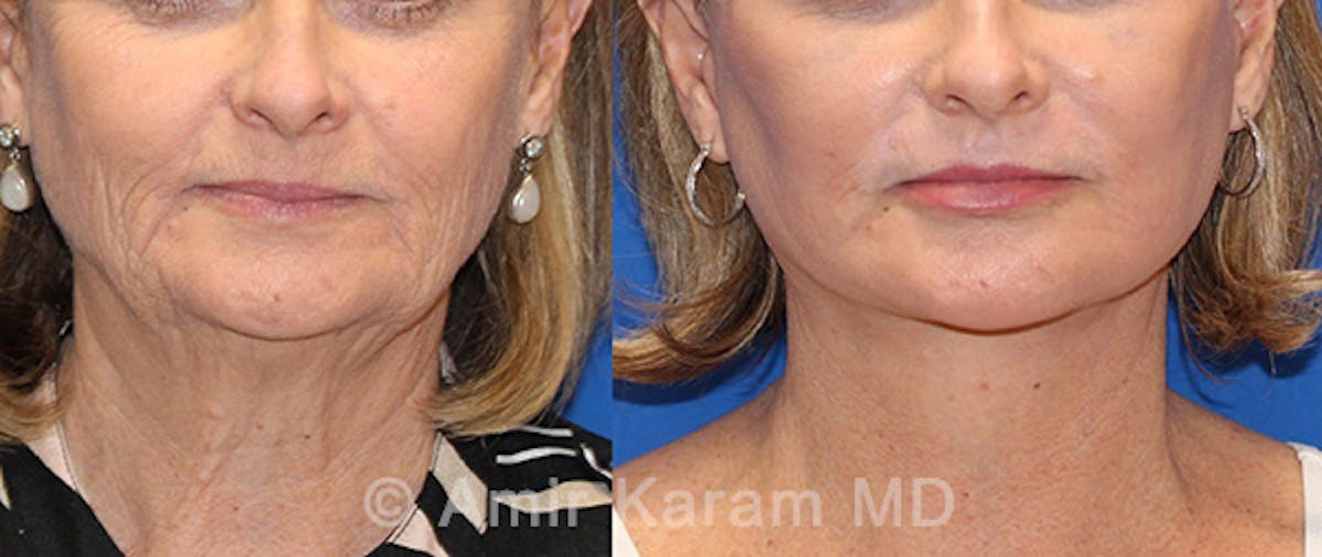 Fat Transfer Before & After Gallery - Patient 71701374 - Image 1