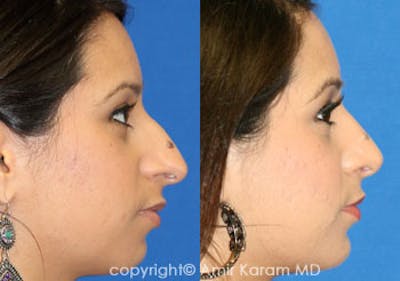 Rhinoplasty Before & After Gallery - Patient 71701372 - Image 1