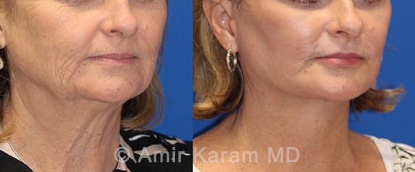Fat Transfer Before & After Gallery - Patient 71701374 - Image 2