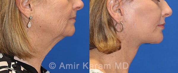 Fat Transfer Before & After Gallery - Patient 71701374 - Image 3