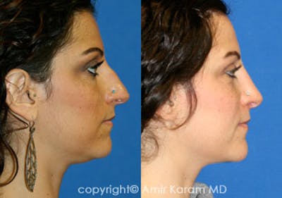 Rhinoplasty Before & After Gallery - Patient 71701375 - Image 1
