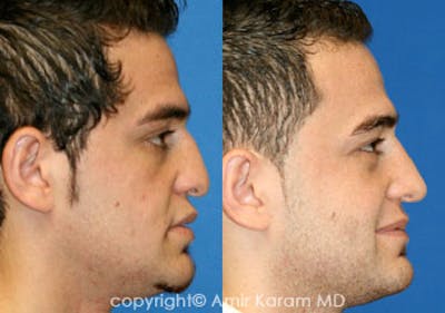 Rhinoplasty Before & After Gallery - Patient 71701383 - Image 1